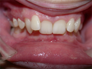 implantes dentales